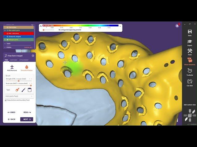 Custom Tray design in Exocad #digitaldentistry #implants #exocad