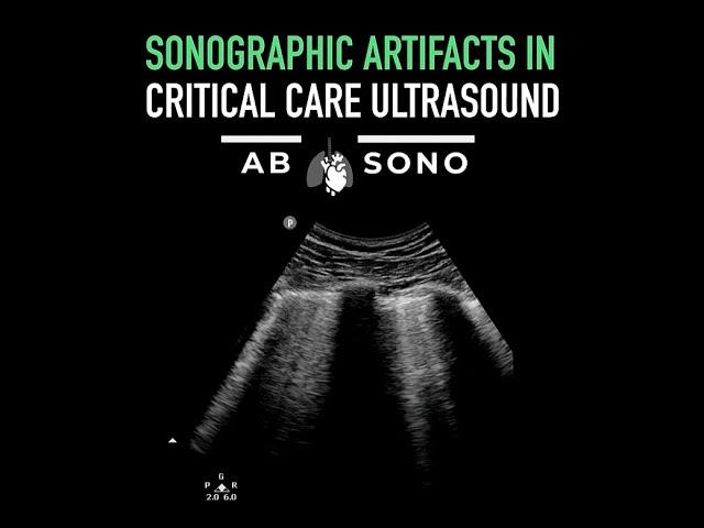 Alberta Sono presents: Sonographic artifacts in critical care ultrasound