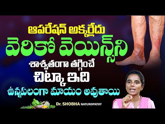 #VaricoseVeins Treatment | Health Tips in Telugu | Relief from Nerve Swelling | Hi Tv Telugu