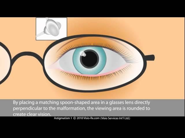 Cylinder in Prescription Glasses. Astigmatism Correction.