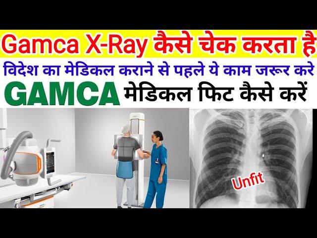 X-Ray Fit kaise kare | X-ray check kaise kare | gamca medical xray unfit kaise thik kare | #gamca