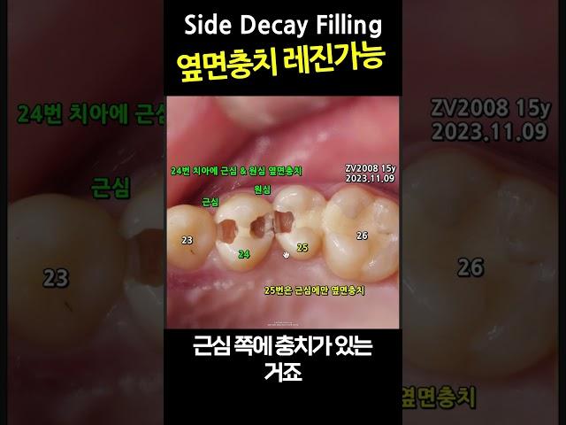Side Decay Filling