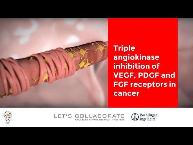 Triple angiokinase inhibition of VEGF, PDGF and FGF receptors in cancer