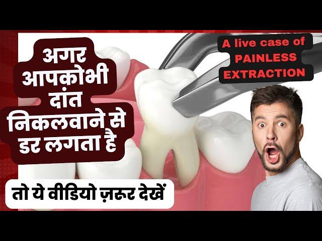 अगर आपको भी दांत निकलवाने से डर लगता है तो यह वीडियो जरूर देखें-Painless tooth extraction -LIVE