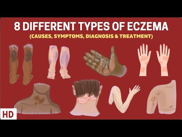 Eczema Exposed: 8 Types You Need to Know