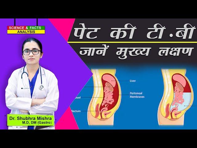 पेट की टी बी जानें मुख्य लक्षण  || Abdomen Tuberculosis