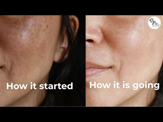 How to treat melasma | Best Melasma and Hyperpigmentation Treatment | Fixderma Skarfix Tx