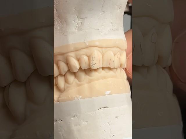 Performing a Diagnostic Wax-Up @EnvisiontecMain #envisiontec #dental #teeth #smile #lsk121shorts