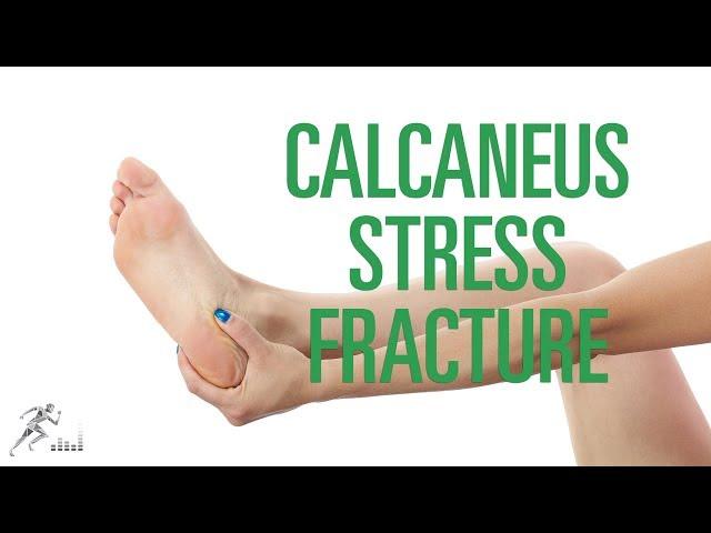 Calcaneus stress fracture: Signs, symptoms and treatment options