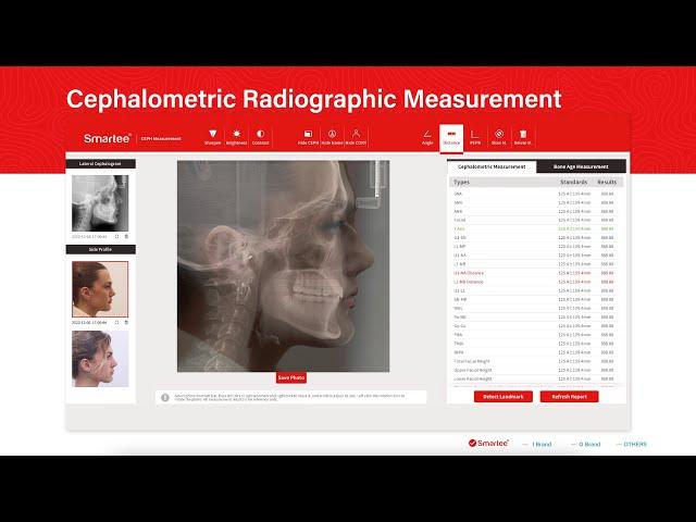 Smartee CEPH Measurement