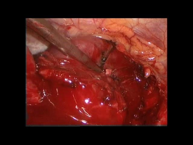 VATS excision of posterior mediastinal mass by Dr. Amit Patil & Dr. Rajesh Mistry