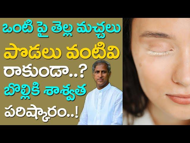 ఒంటి పై తెల్ల మచ్చలు రాకుండా చేసే రెమెడీ | Bolli Machalu | Vitiligo | Dr Manthena Satyanarayana Raju