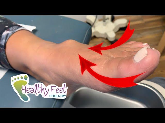 LARGEST CYST IN FOOT DOCTOR HAS EVER SEEN