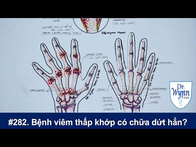 # 282. Viêm thấp khớp có thể chữa dứt hẳn? Cập nhật chẩn đoán và chữa trị