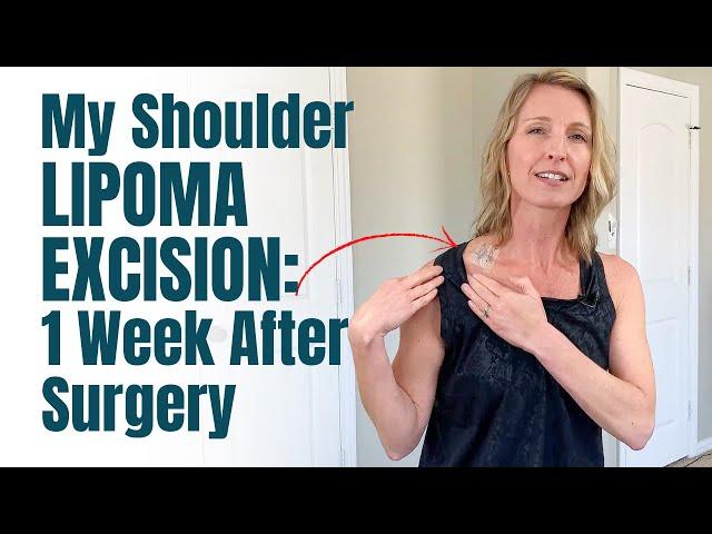 My Shoulder Lipoma Removal: 1 Week Post Surgery