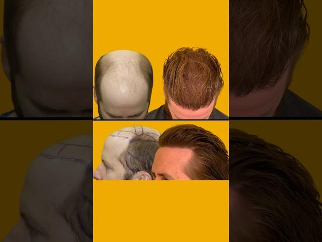 12k Grafts ALL SCALP- Dr. Zarev