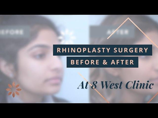 Rhinoplasty Transformations at 8 West Clinic in British Columbia - Before & After | Dr. Buonassisi