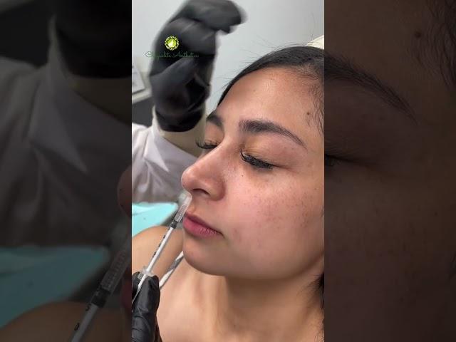 Botox Nose Lift