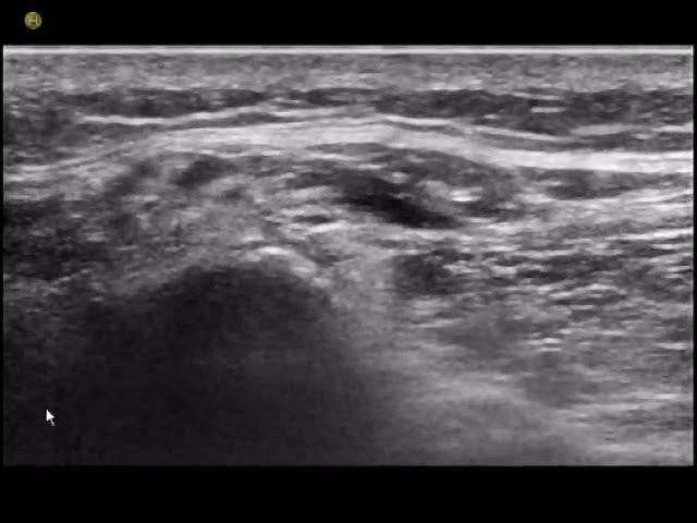 Ultrasonographic Technique for Imaging and Injecting the Superior Cluneal Nerve