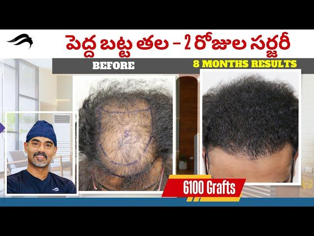 Hair Transplant In Hyderabad | Best Results  Cost & Center Of Hair Transplant Surgery In Hyderabad