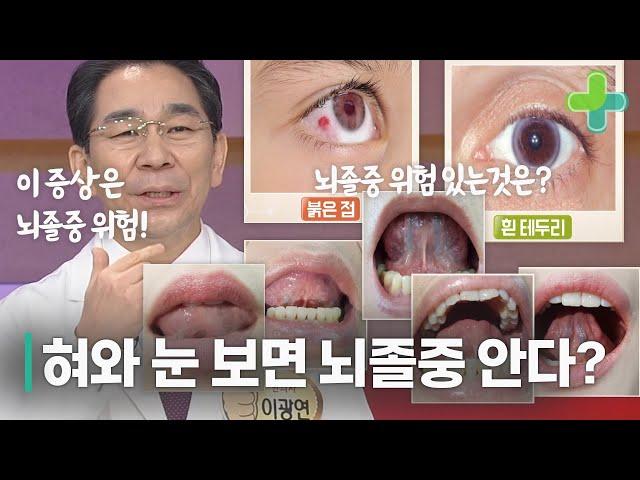 혀와 눈을 보면 뇌졸중인지 알 수 있다?