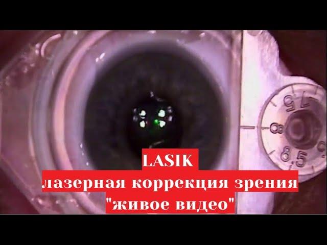 ЛАСИК  - "живое" видео  операции лазерной коррекции зрения по методу LASIK в Москве