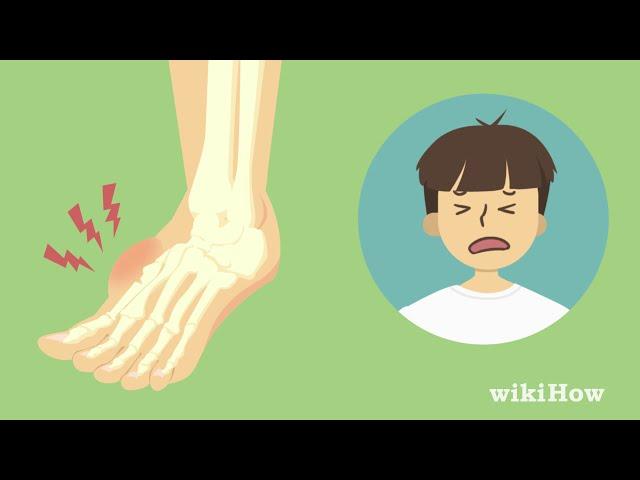 How to Tell If Your Foot Is Broken