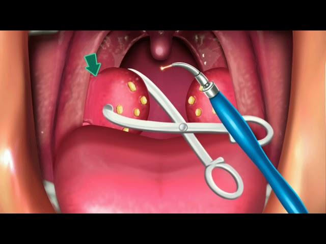 Animation Surgery of Tonsillectomy & Adenoids