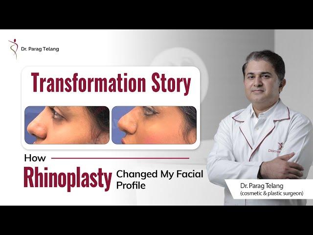 Patient Testimonial about Rhinoplasty | Best Plastic Surgeon in Mumbai | Designer Bodyz