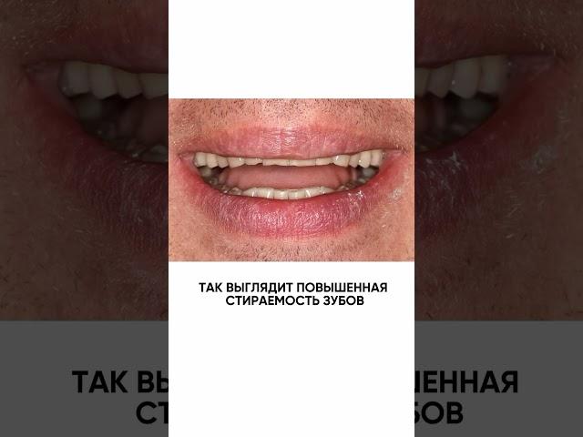 Патологическая стираемость зубов - восстановили функцию и эстетику винирами