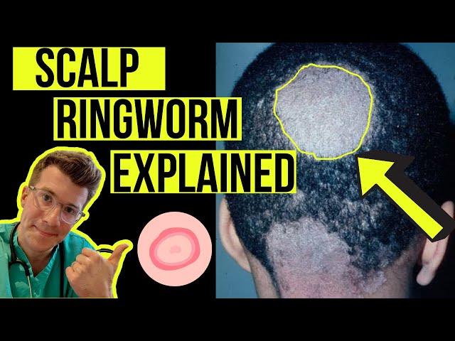 Doctor explains Scalp Ringworm (Tinea Capitis) including causes, symptoms, treatment & more!