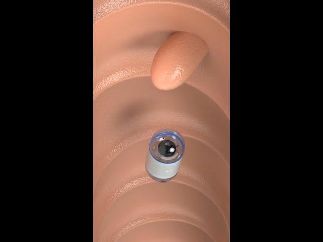 Capsule Endoscopy #science #shorts #medicine