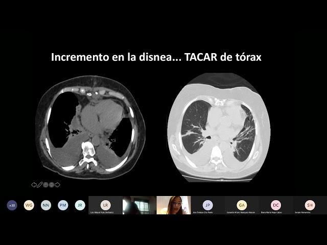 Caso: “Enfrentando lo desconocido: Cuando pensar en falla cardiaca no es suficiente”