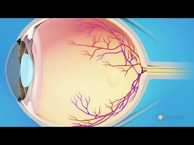 What causes a macular pucker?