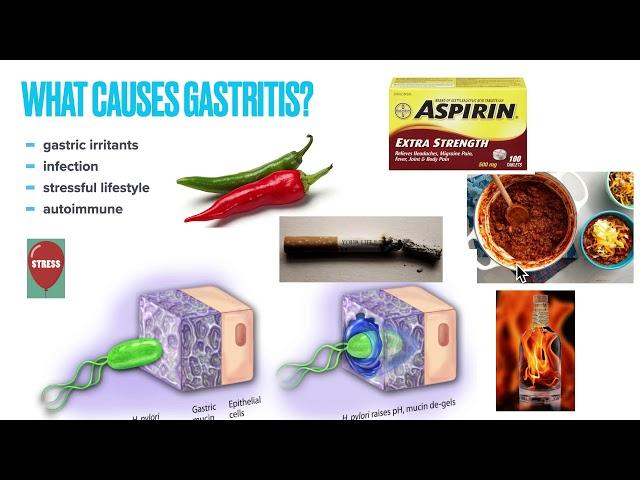 Chronic Gastritis: Causes, Symptoms, Treatment,  Prevention, Why treatment fails and How to fix it!!