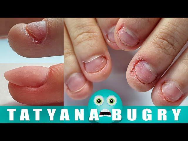 Transformation On EXTREMELY Bitten Nails | Fixing Bitten Nails With Polygel | Russian ,Efile Mani