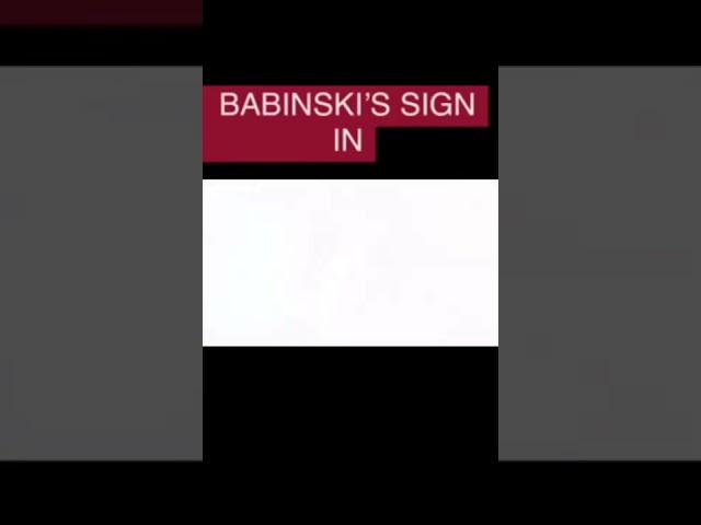 Babinski sign in baby.   #navdeepyadav  #navdeep  #navdeep yadav