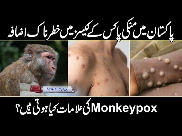 Alert ! Monkey pox Virus Spreading in Pakistan | Symptoms & Causes & Treatment