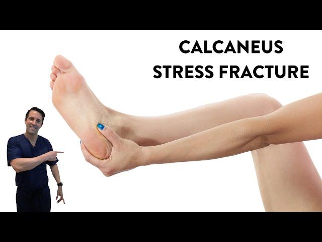 Does shockwave treatment help a calcaneus stress fracture heal?