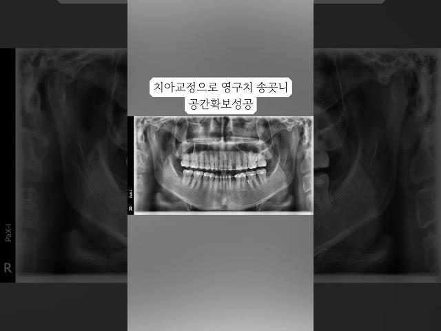 성인때 까지 남아있는 조그마한 젖니 보기 싫다면? #임플란트 가 해답입니다.(02 886 2877신도림역 가이치과) #서울임플란트 #임플란트치과 #치과 #서울 #구로구