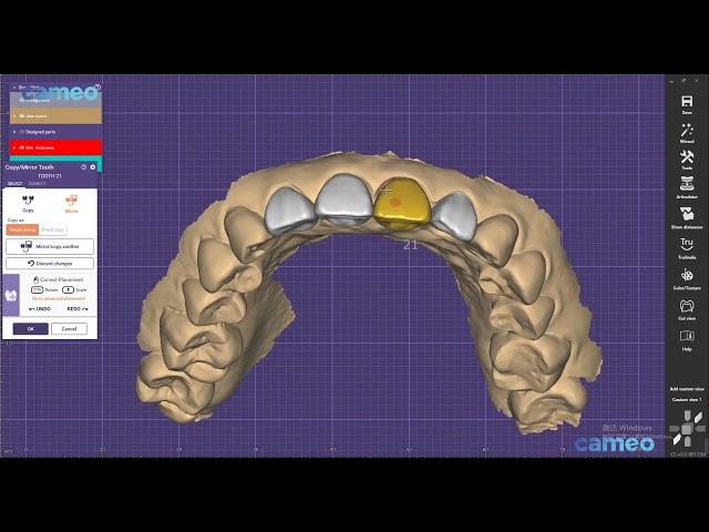 Aidite Exocad design guide: Anterior teeth bridge design