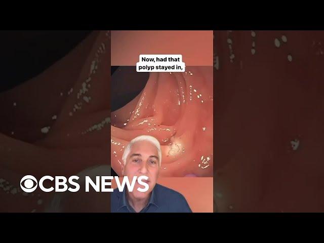 CBS News’ Dr. Jon LaPook demonstrates how colonoscopies can save your life #shorts