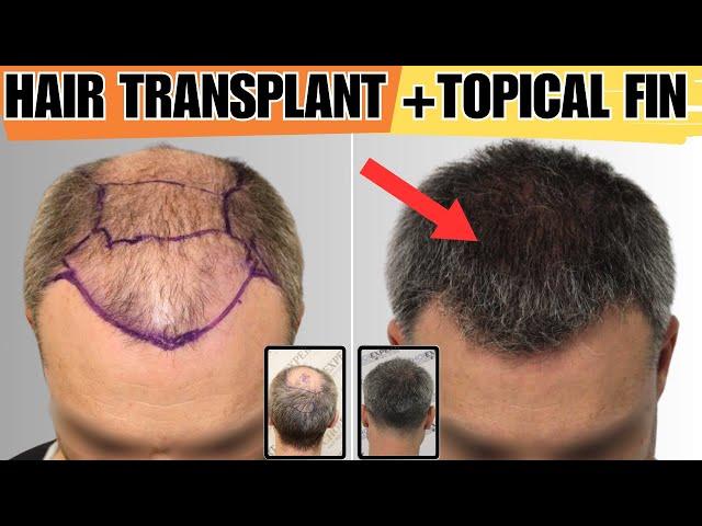 The BEST Treatment For Hair Loss HT+Fin - Choiexpert