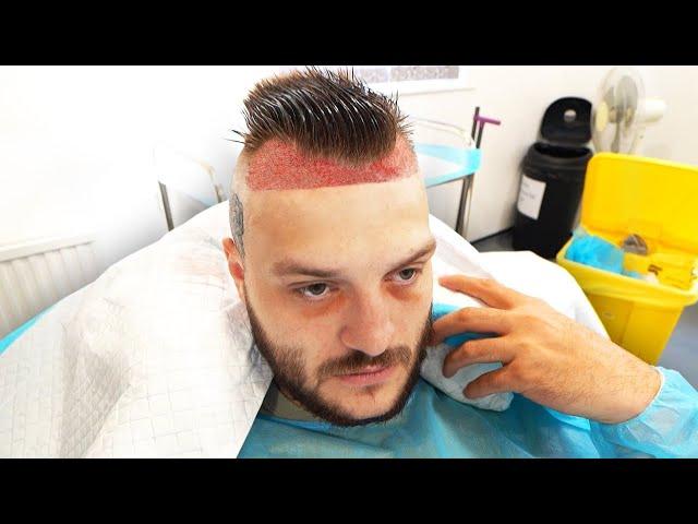 TGF DO IT #6 - Hairline Surgery Edition