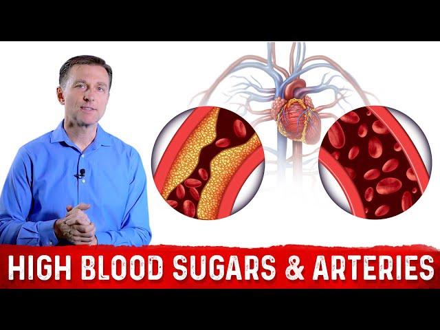 The Effects of High Blood Sugar on Arteries – Dr. Berg on Arteriosclerosis & Atherosclerosis