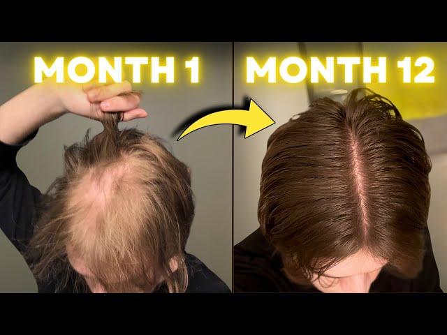 FINASTERIDE Stopped My Hair Loss in 1 YEAR!