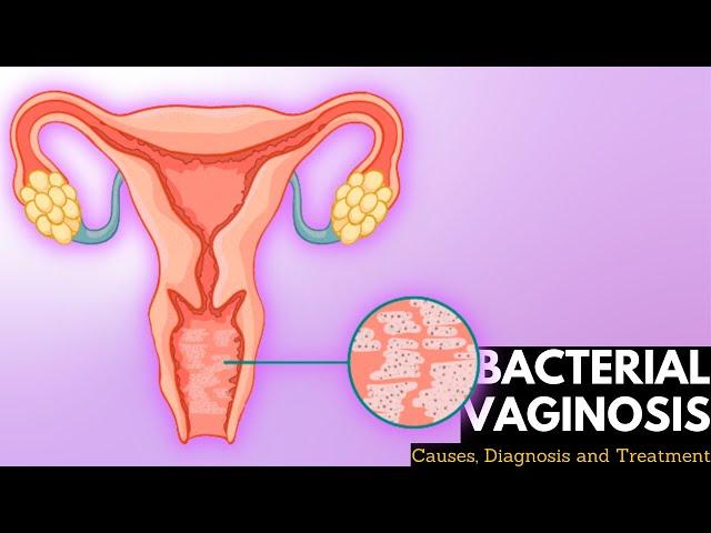 Bacterial vaginosis, Causes, Signs and Symptoms, DIagnosis and Treatment.