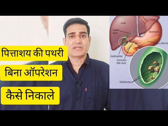 पित्ताशय की पथरी बिना ऑपरेशन कैसे निकाले । Gallbladder stone #shorts