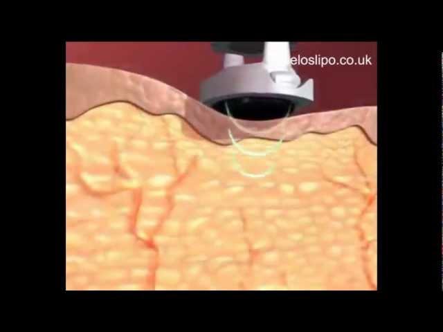 How Ultrasonic Cavitation Works