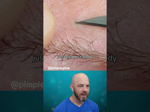 You know this blackhead pop smells BAD(credit: @pimpleglow on TT) #pimplepop #satisfying #blackhead